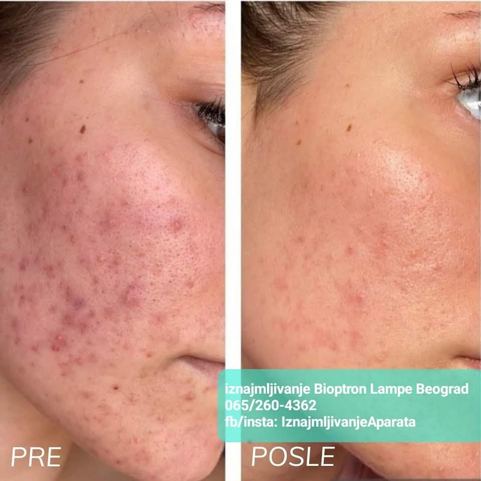 Bioptron lampa problemi sa kozom pre i posle bioptron pro 1 iskustva korisnika iznajmljivanje rentiranje renta bioptrona 